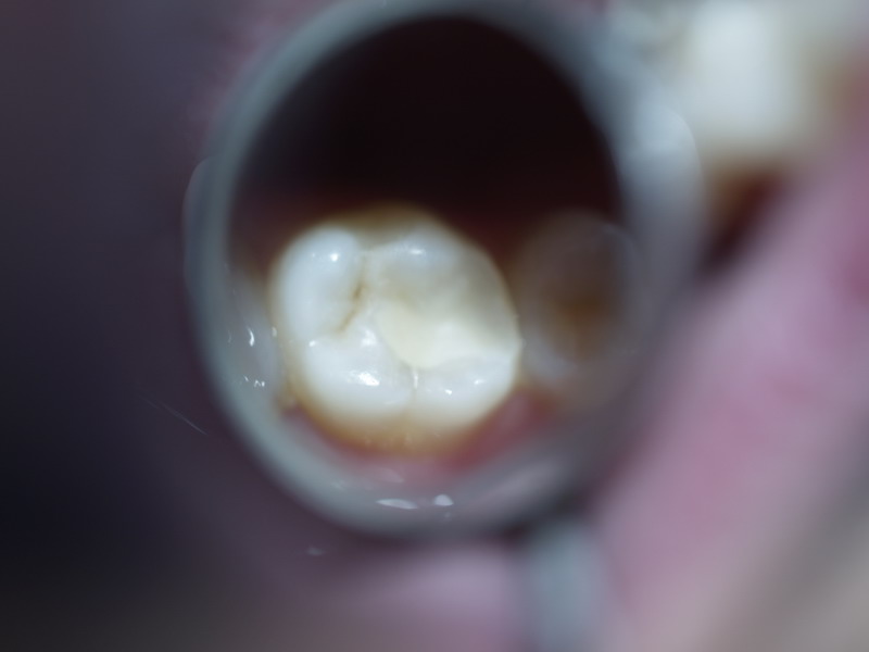 Dental materials Clinical evaluation of dental restorative materials