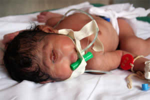 One Eyed Baby Born in India