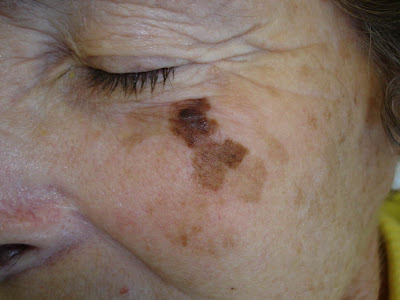 Skin Cancer College of ANZ Journal Updates: July 2007