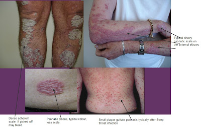 Differential Diagnosis in Dermatology: Red scaly diseases