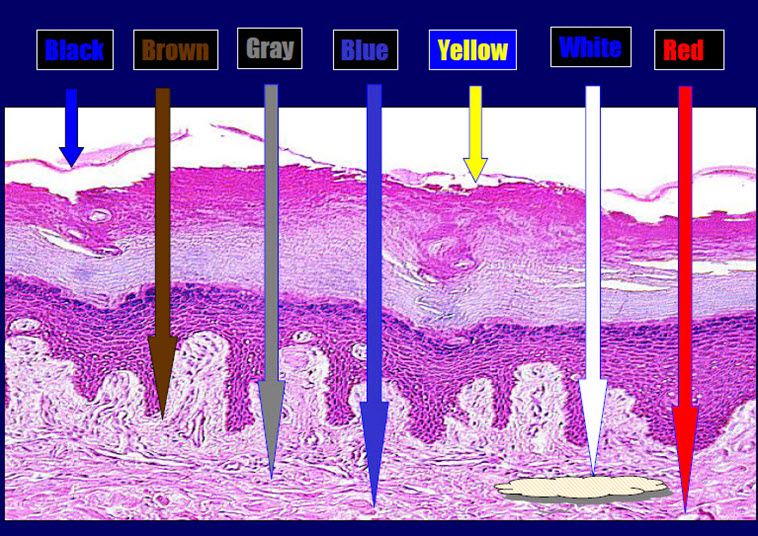 Dermoscopy Made Simple: Colours in Dermoscopy