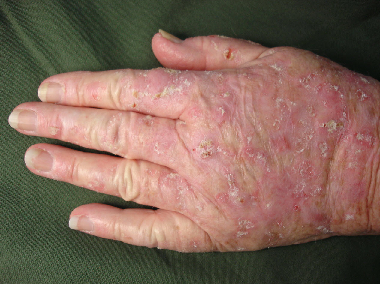 lentigo maligna melanoma Picture Image on MedicineNet.com