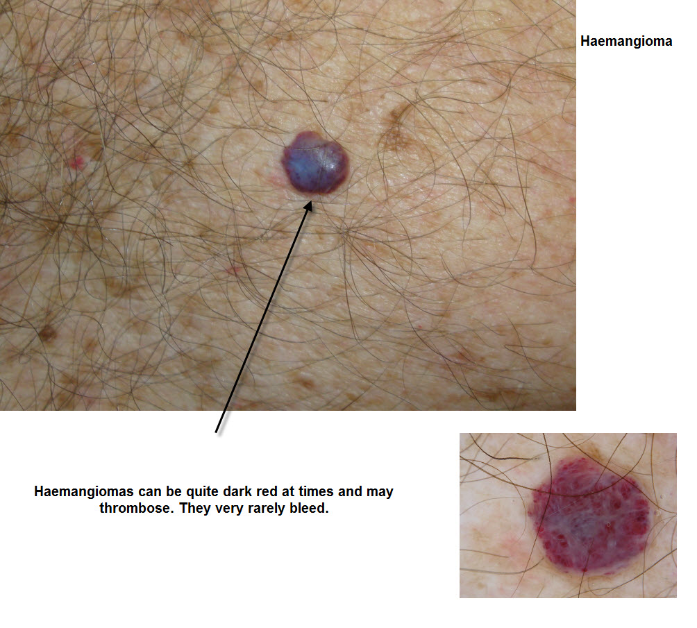 Dermoscopy Made Simple Haemangioma and Angiokeratoma