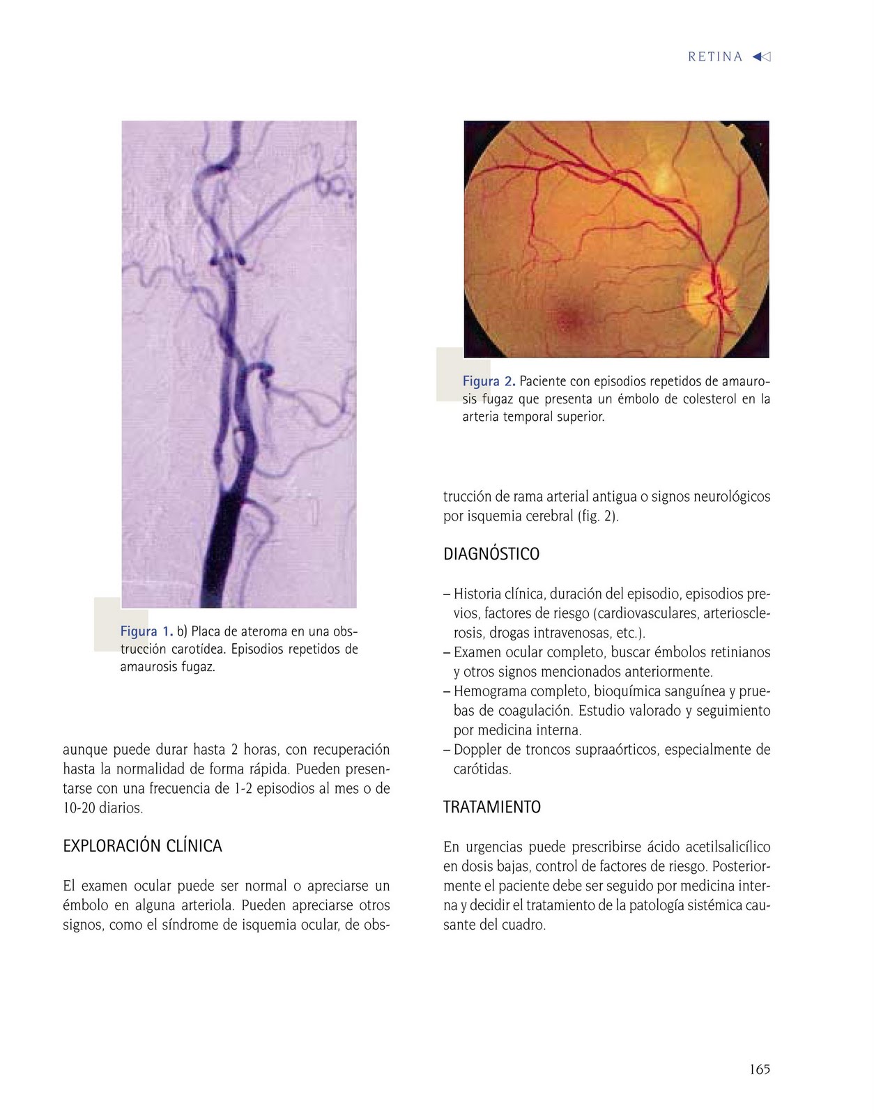TM Oftalmología: Amaurosis Fugaz