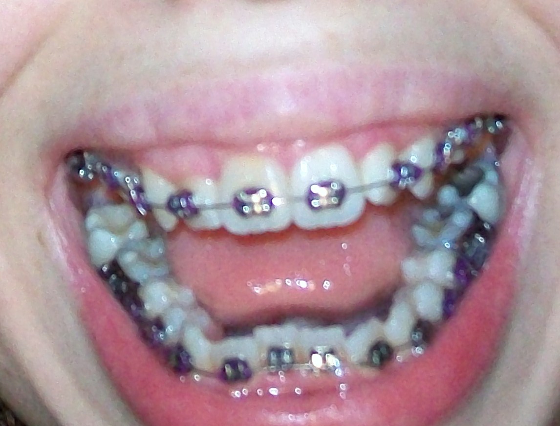 Braces at twenty My First Braces Tightening