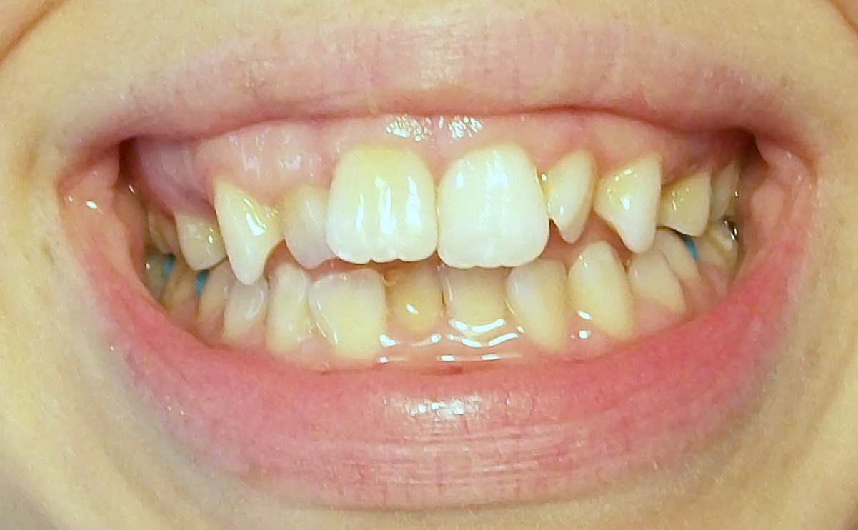 Braces at twenty Spacer and Extraction pictures