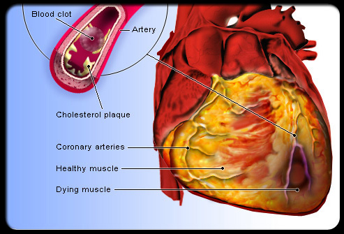 heart disease diagram. Heart Disease (Cardiovascular