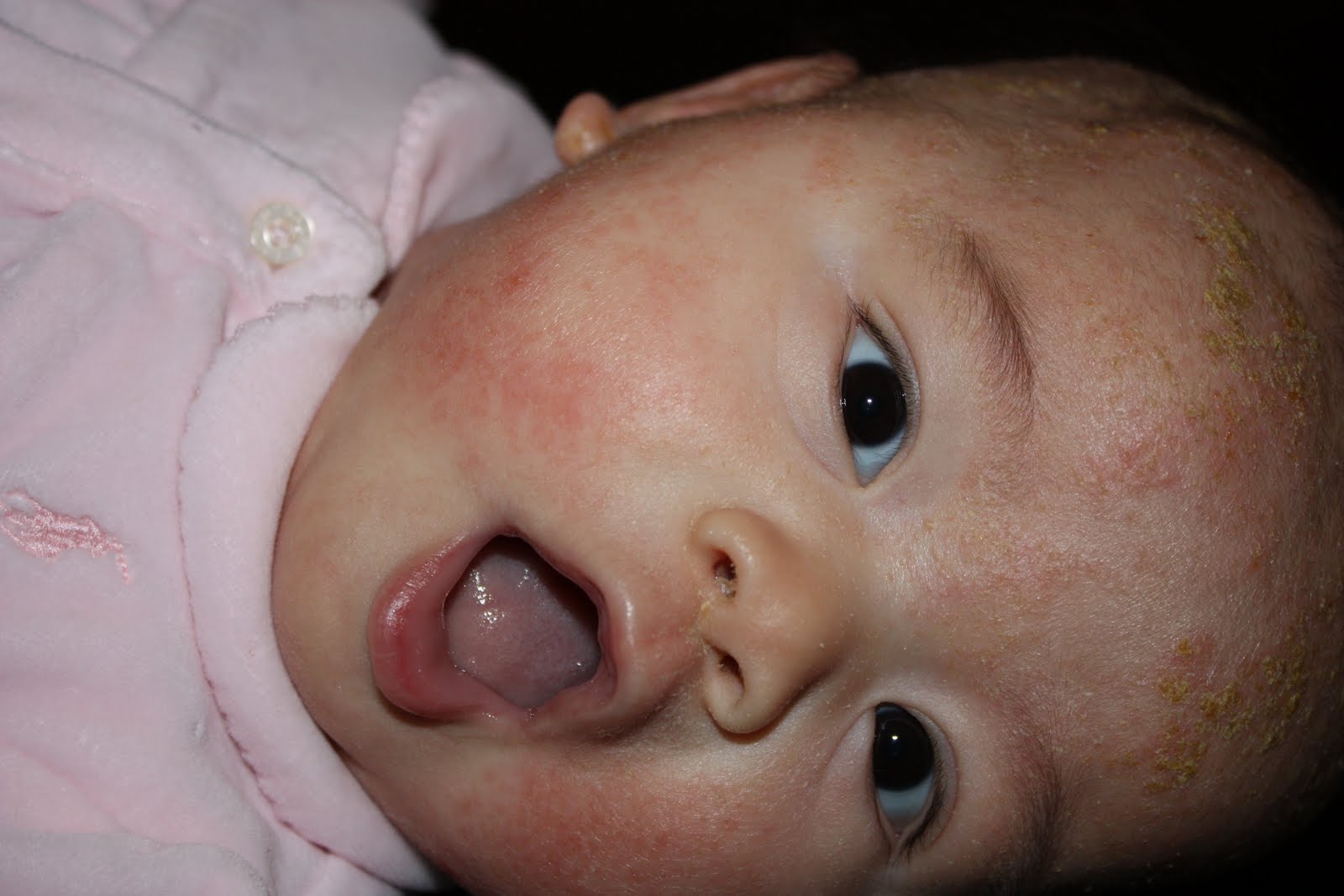 eczema in babies #10