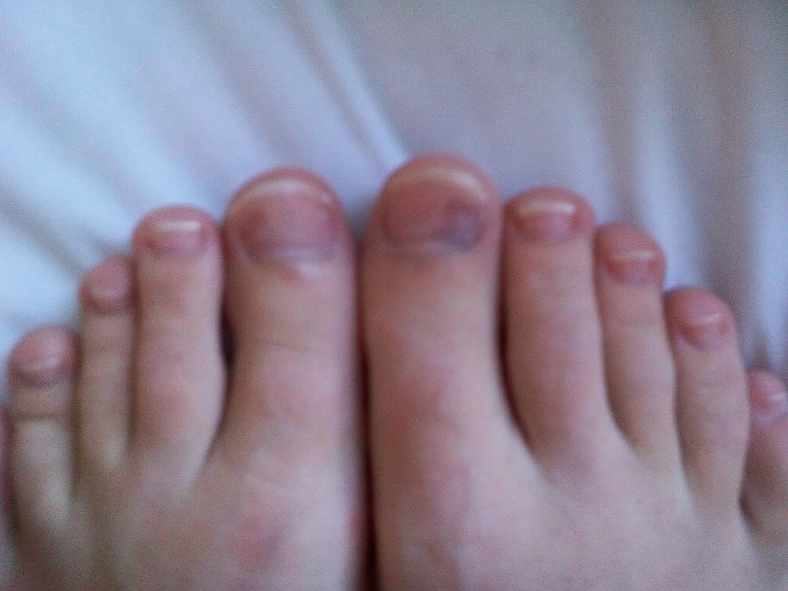 Bruise Under Toenail Won T Go Away Nail Ftempo