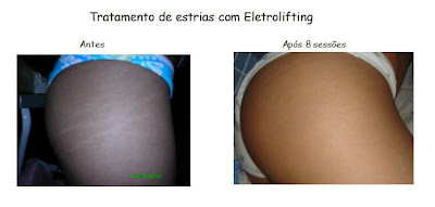 eletrolifting+para+estrias.jpg