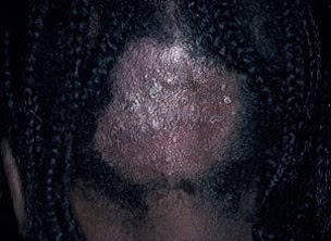 ringworm in hair pictures #11