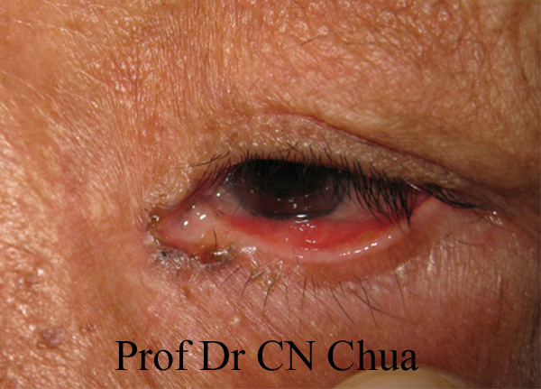 Eyelid Surgery by Prof Dr CN CHUA 蔡鐘能: Common Presentations of Eyelid ...