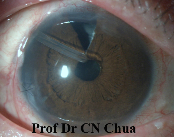 Eyelid Surgery by Prof Dr CN CHUA 蔡鐘能: The Must Have Book for ...