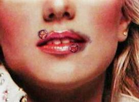 [printablecoldsores.jpg]