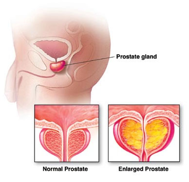 [prostate.jpg]