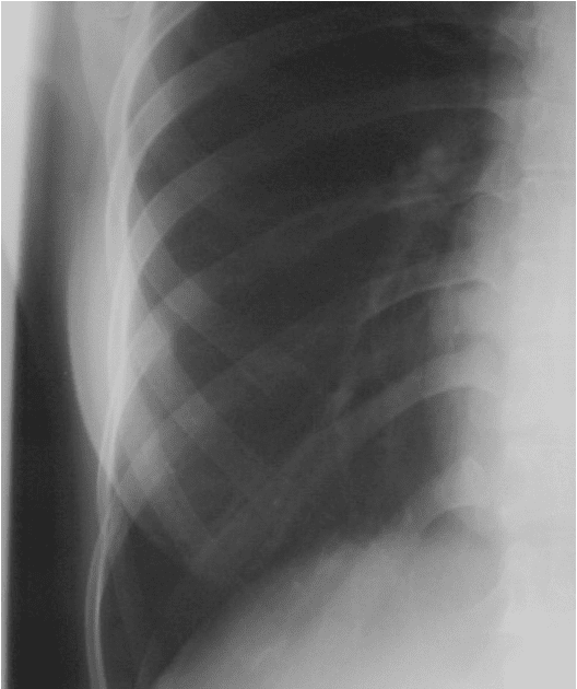 Перелом 10 ребра справа рентген. Рентгеновские снимки переломов ребер. Трещина в ребре что делать