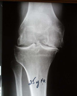 Dr Hassan Medical: Sakit Lutut? Mungkin Osteoarthritis