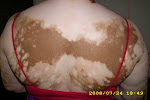 Vitiligo on person's back