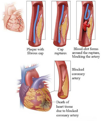 blocked-coronary-artery-diagram
