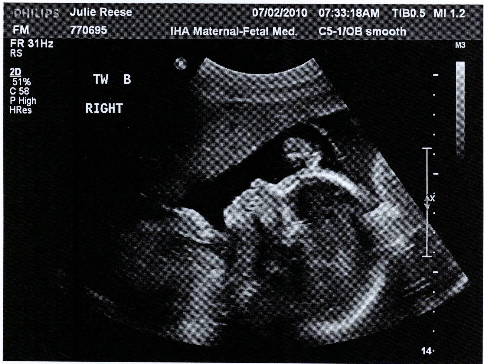 Reese Adventures: Week 26 Ultrasounds