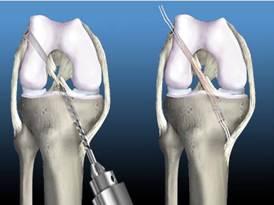 Операция на передней крестообразной связки коленного. Операция на передней крестообразной связки коленного. Протез передней крестообразной связки. Артроскопическая резекция медиального мениска. Пкс (передняя крестообразная связка).