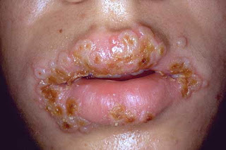 donde se presenta el herpes genital
