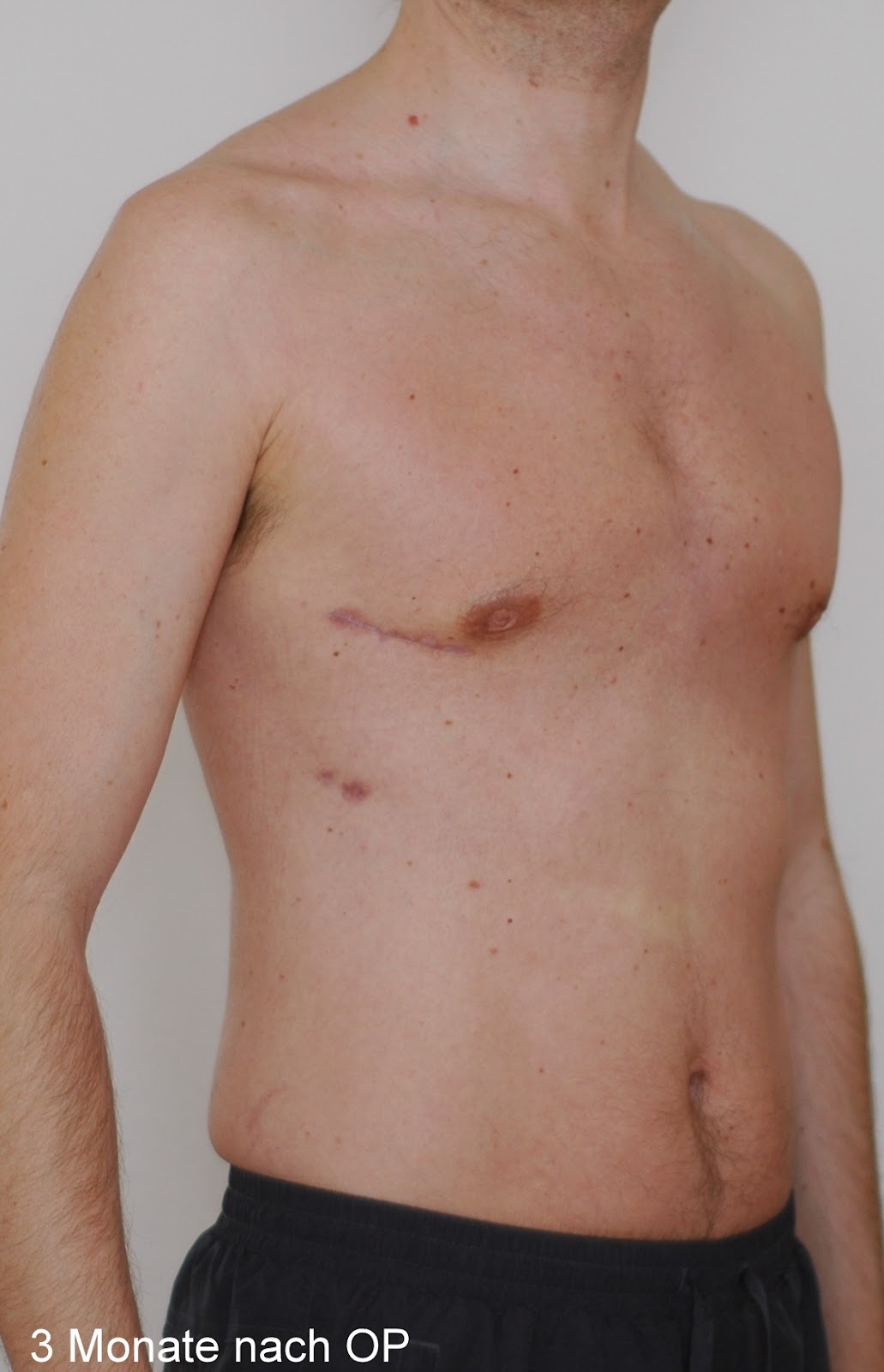 ExPectusBlog Tag 92 drei Monate nach meiner TrichterbrustOP