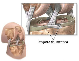 meniscos cirugia lesion rodilla