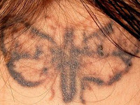 Derma pricking-remove unwanted tattoo