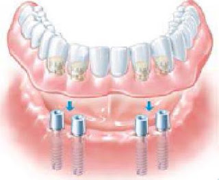 Dental Poland: SynCone Ankylos Implants