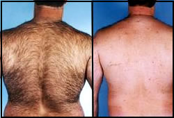 [lazerepilasyonkillar.jpg]