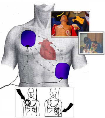 aed defibrillator placement heartstart philips apical anterio defibrillators defibrillation attempted unsuccessful electrodes posterior