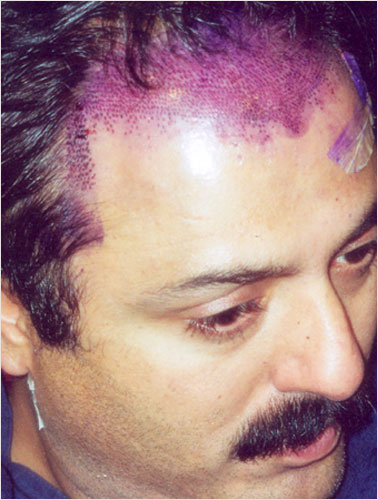 NOMAN EJAZ (BEFORE SURGERY)