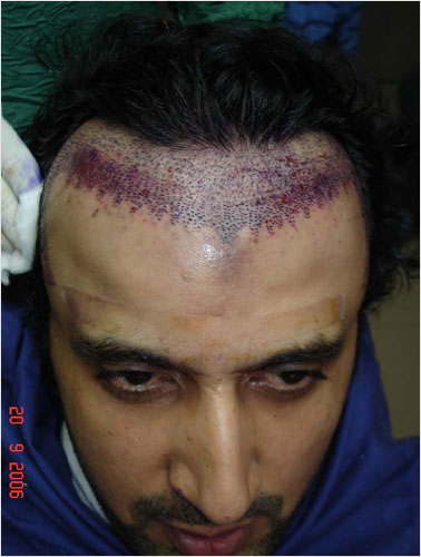 ASAD (BEFORE SURGERY)