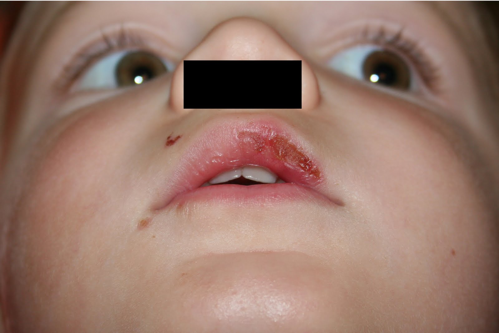 Scabs on lips turning black - Doctor answers on ...
