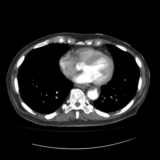 Radiology Cases: Penetrating Descending Thoracic Aortic Ulcer