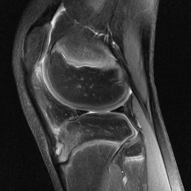 Radiology Cases Osgood Schlatter Disease