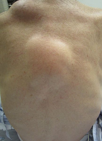 Lipoma – Pictures, Symptoms, Causes, Removal, Treatment