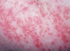 Skin Yeast Infections