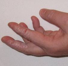 Hand Yeast Infection