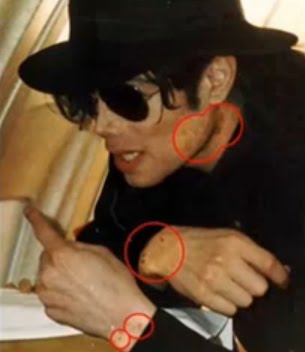 [MJ+vitiligo+7.jpg]