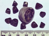 Gallbladder Stones: Size Of GallStones
