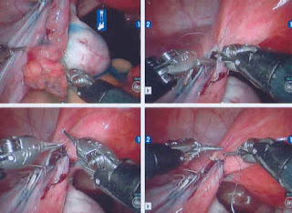 tubal reversal ligation after surgery robotic arms pregnancy suturing segments together