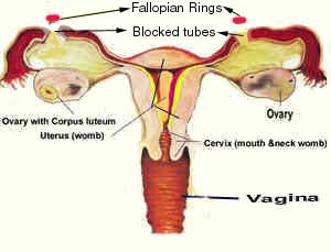 tubal ligation tubes reversal female fallopian sterilization tube
