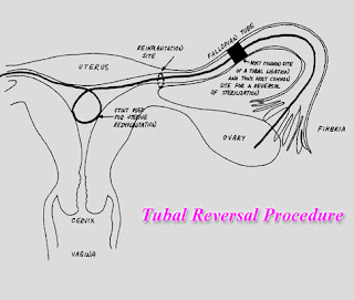 tubal ligation reversal
