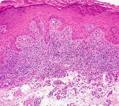 Вид эпулиса в зависимости от гистологической картины