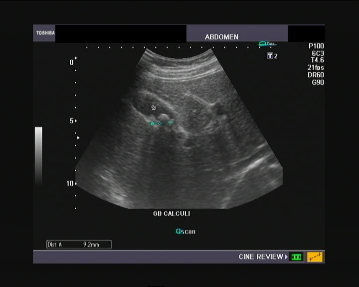 Ultrasound and Color Doppler videos Pelvic kidney ultrasound video study