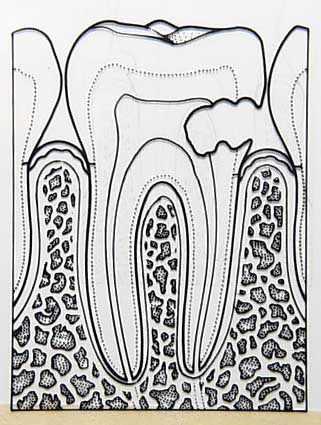 [80009535caries.jpg]