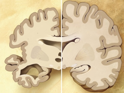 Alzheimers degenereret hjernehalvdel, sammenlignet med normal