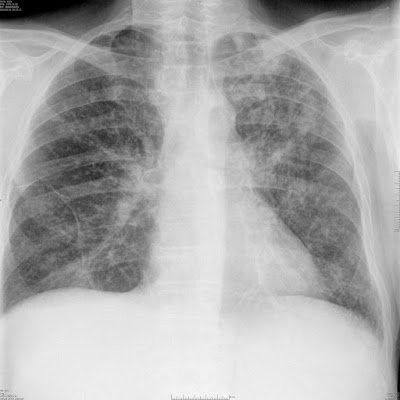 Postprimer miliáris tuberculosis